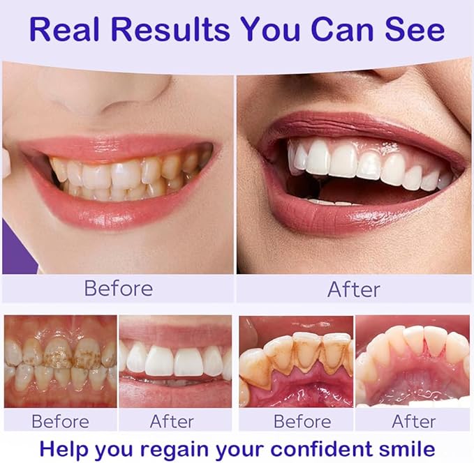 Teeth Whitening Powder with 20,000ppm Hydroxyapatite & 20,000ppm Niacinamide – Instant Brightening, Patent-Pending R5X Remineralizing Complex, Purple Color Corrector Mint Formula, 50g, 3-Month Supply