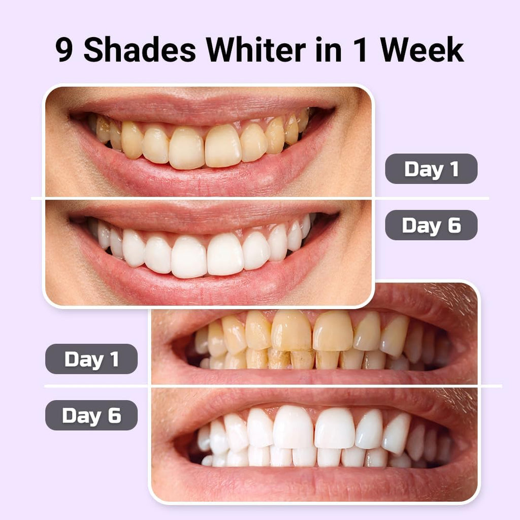 Teeth Whitening Kit – LED Light & Whitening Gel with Remineralization Syringes – Professional-Grade Whitening for Sensitive Teeth – Removes Stains from Coffee, Wine, & Smoking