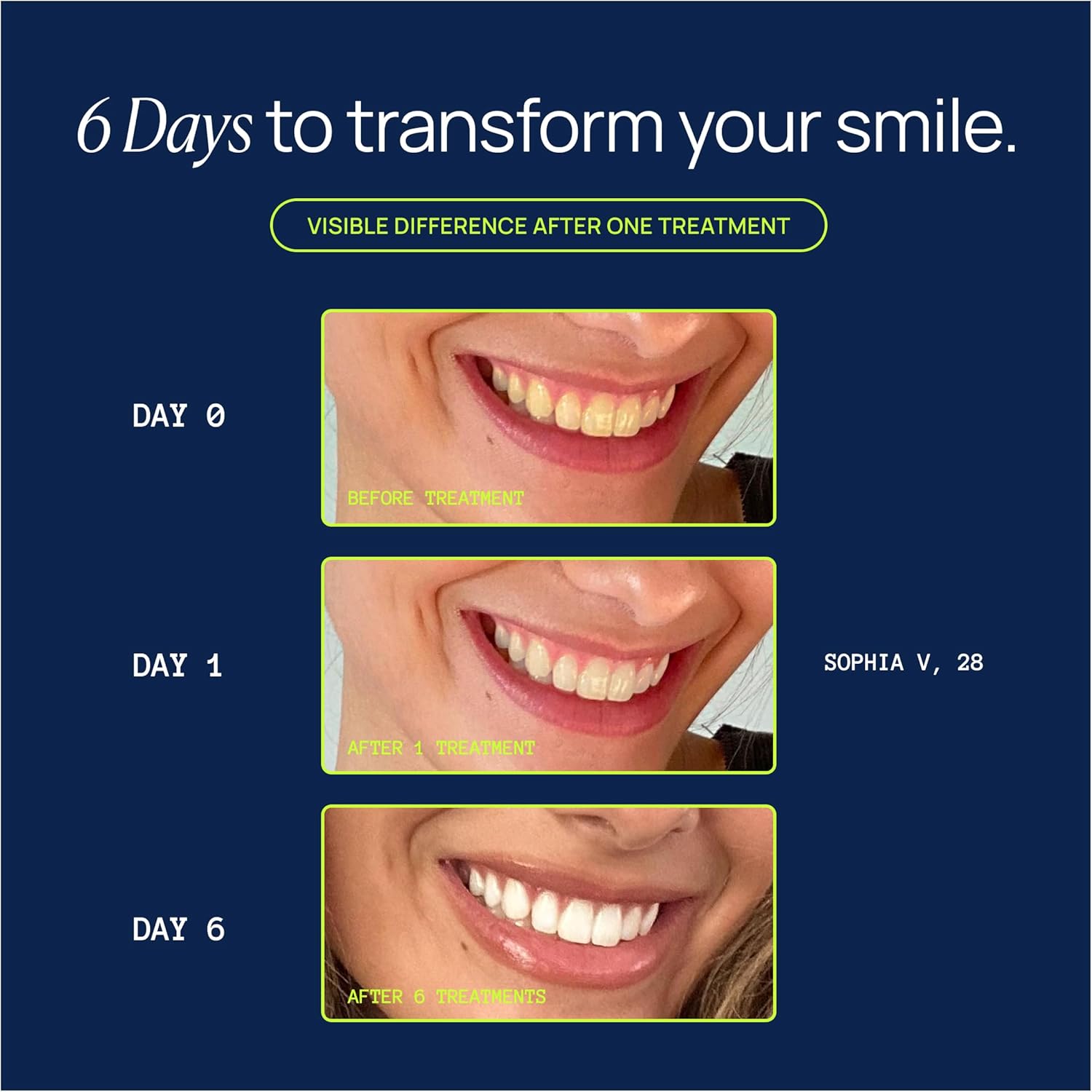 Laughland Gentle Teeth Whitening Gel 3 Pack, Tooth Whitener, Made with Sodium Bicarbonate, Glycerin, Aloe Vera & Mint, Gentle on Sensitive Teeth, at Home Dental Care, Travel Friendly, 6 Treaments