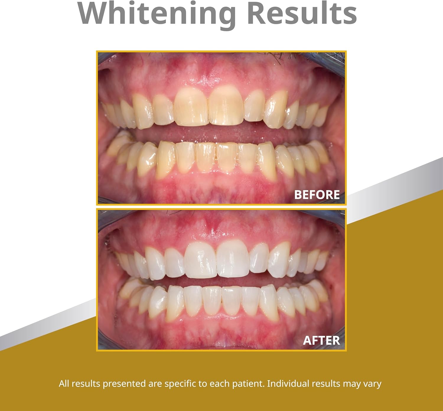 Opalescence 45% Syringes Teeth Whitening Gel - with PF - (8 Syringes) Refill Kit Carbamide Peroxide. Made by Ultradent, in Mint Flavor. Tooth Whitening 5359-4