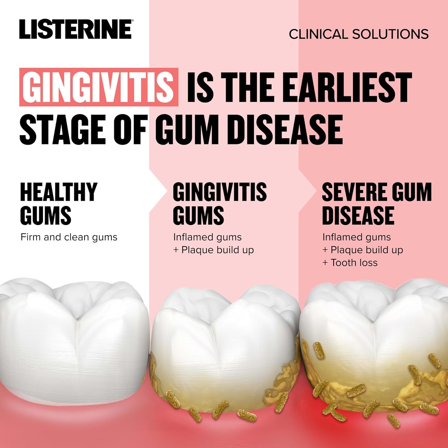 Listerine Clinical Solutions Gum Health Antiseptic Mouthwash, Antigingivitis & Antiplaque Oral Rinse Kills Germs for Healthier Gums, Reduces Gingivitis in 1 Week, ICY Mint, Twin Pack, 1 L, 2 Pack