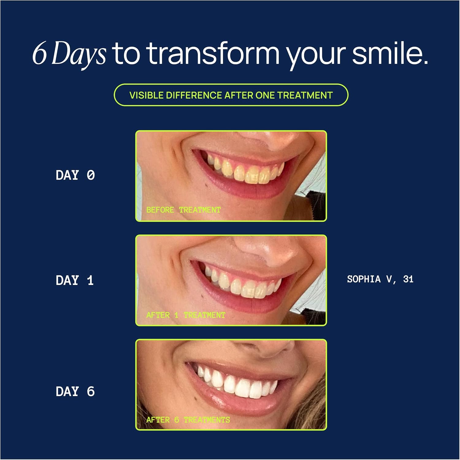 Laughland Original Teeth Whitening Kit, Phone-Powered LED Mouthpiece & 3 Whitening Gel Syringes, 8% Hydrogen Peroxide, Aloe Vera & Mint, for Sensitive Teeth, at-Home Dental Care, 6+ Treatments