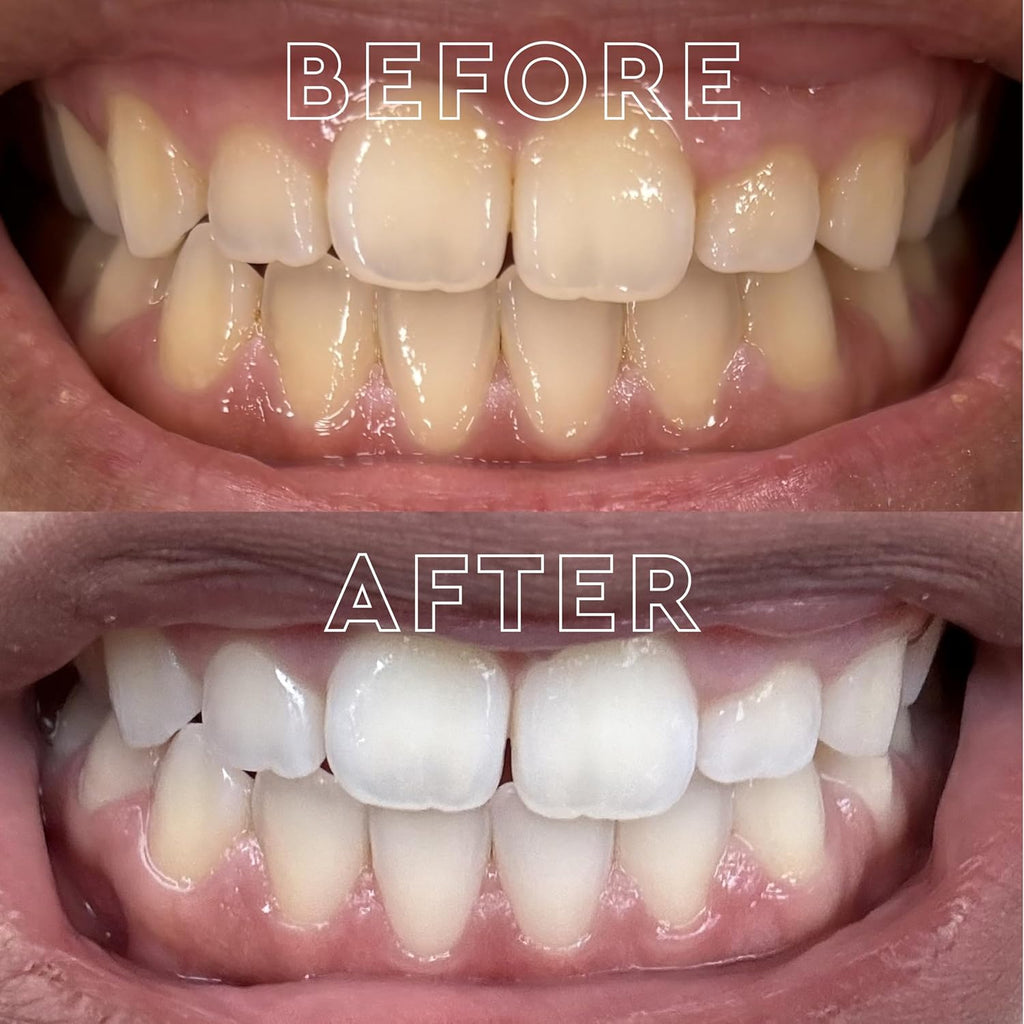 MOON Dissolving Teeth Whitening Strips, 28 Platinum Express No Rinse White Strips, Winter Mint, Hydrogen Peroxide & Essential Oils, Whiten Sensitive Teeth up to 8 Shades in 1 Week, Travel Essentials