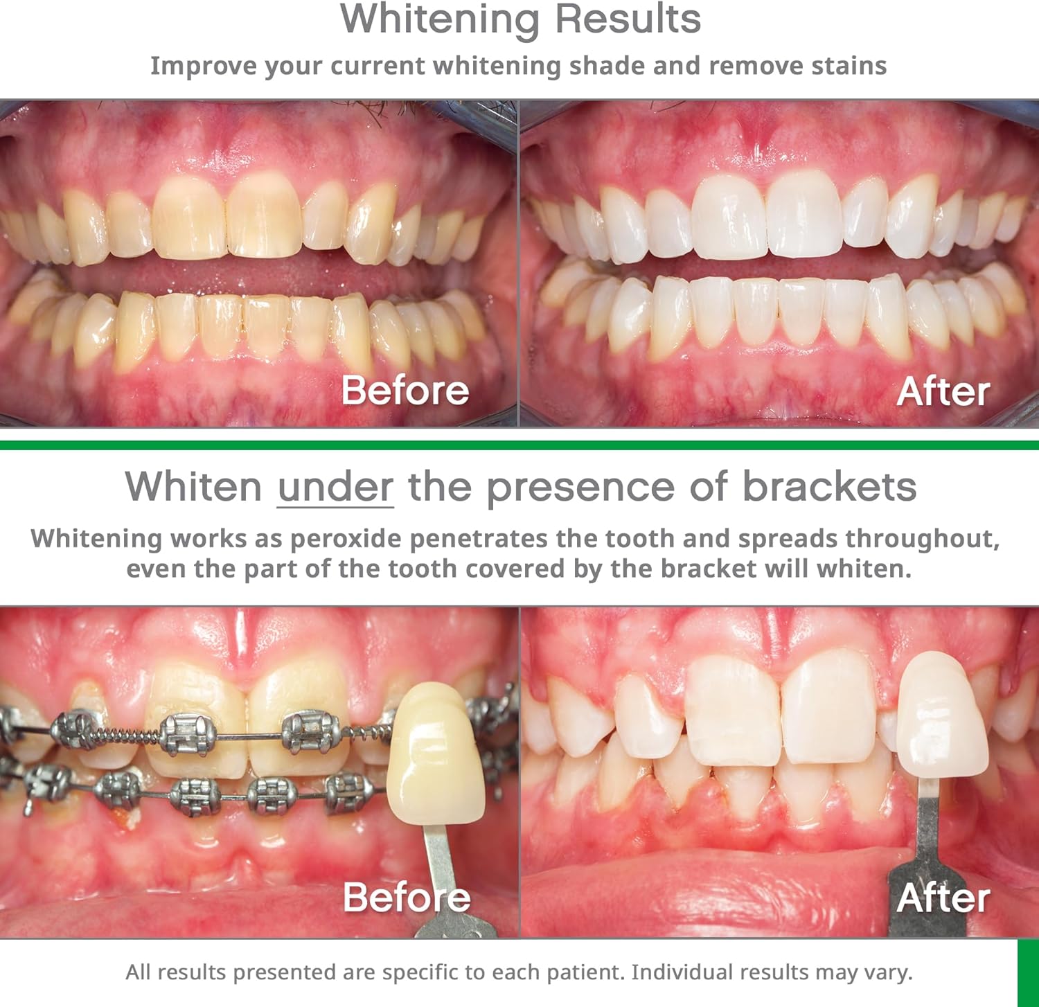 Opalescence Teeth Whitening Bundle - Opalescence Go 15% Hydrogen Peroxide Prefilled Trays (10 Trearments) and Sensitive Whitening Toothpaste 4.7 Onz - Mint Flavor 5194-5167