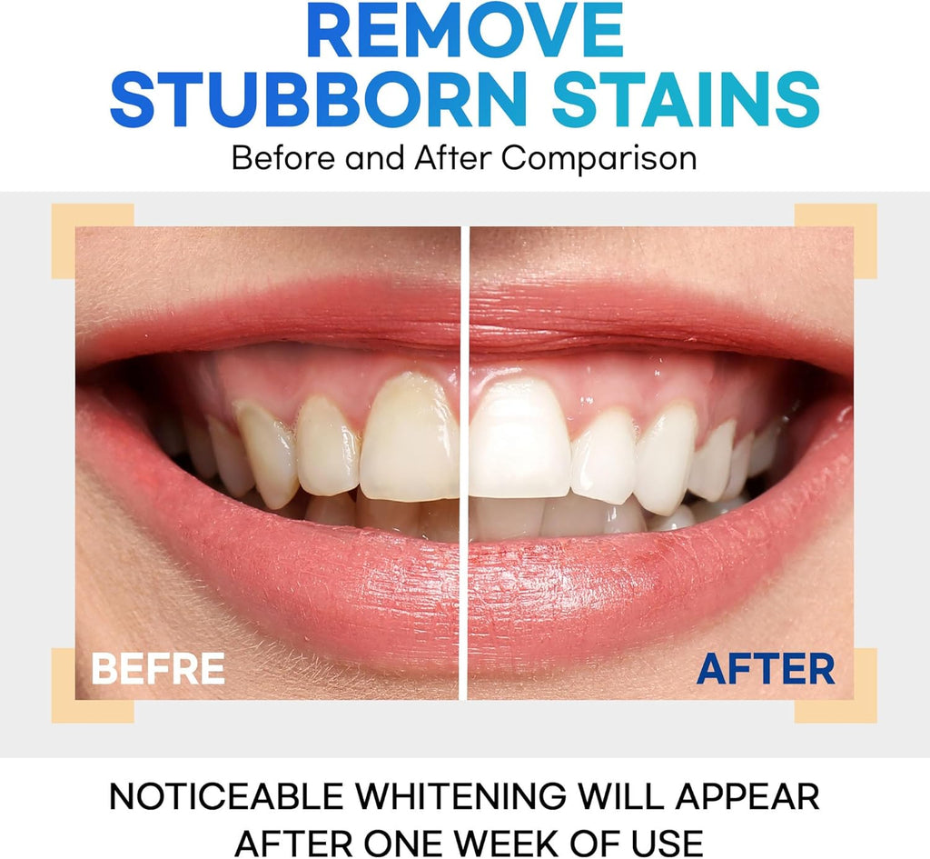 Teeth Whitening Gel – Set of 3 – Gentle, Pain-Free Formula for Sensitive Teeth – Easy, Mess-Free Application – Travel-Friendly & Enamel-Safe for a Brighter Smile