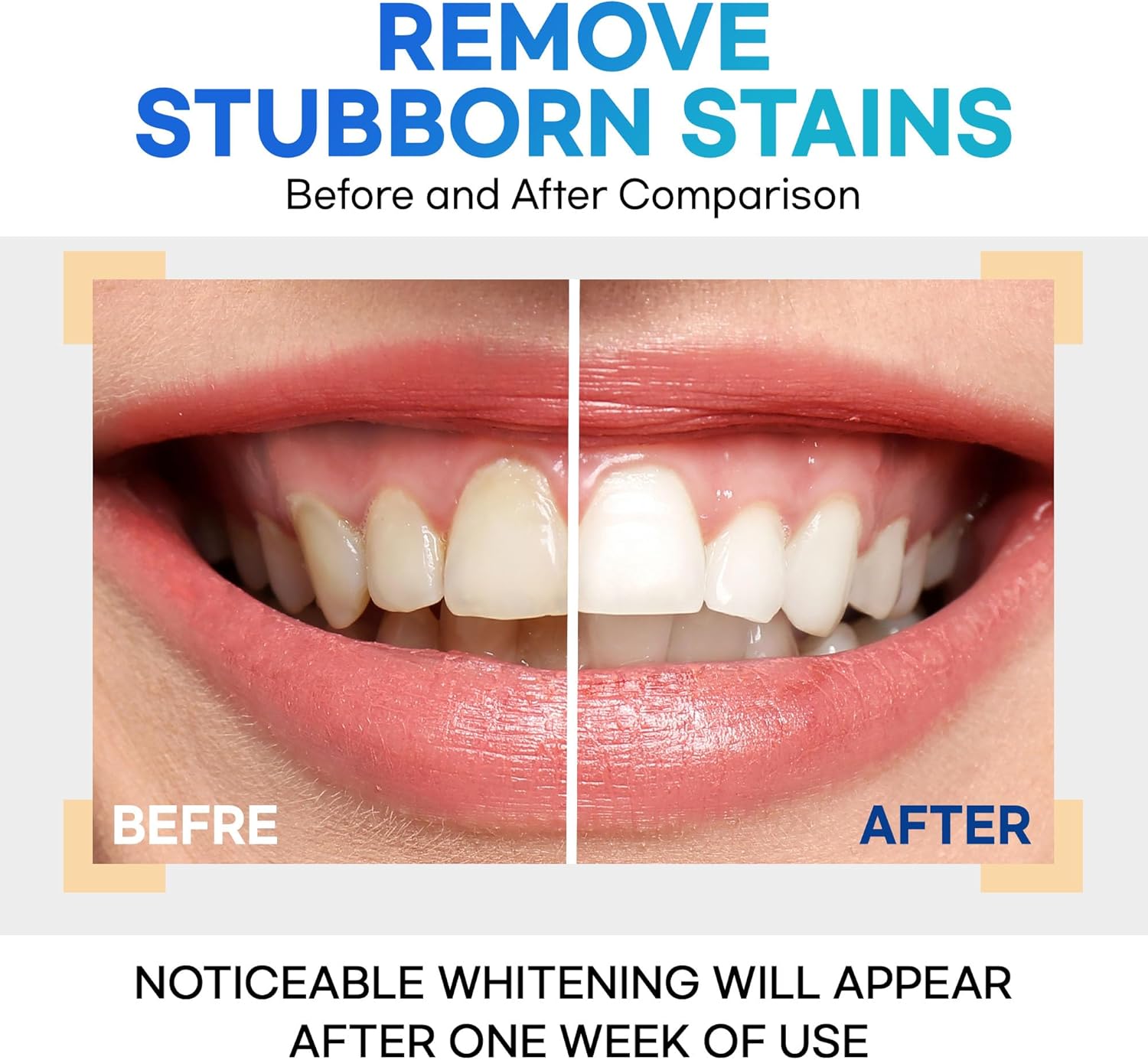 Teeth Whitening Gel – Set of 3 – Gentle, Pain-Free Formula for Sensitive Teeth – Easy, Mess-Free Application – Travel-Friendly & Enamel-Safe for a Brighter Smile